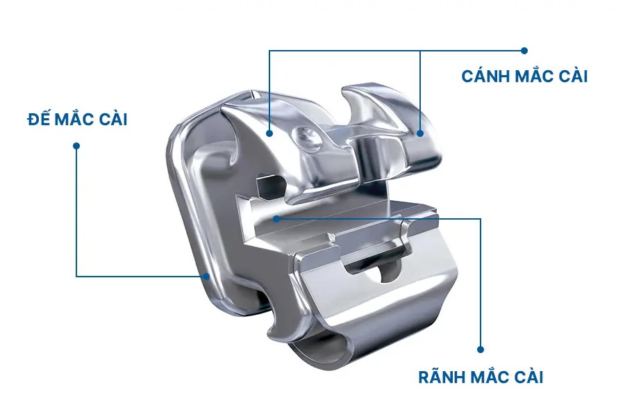 Cấu tạo của mắc cài kim loại trong chỉnh nha